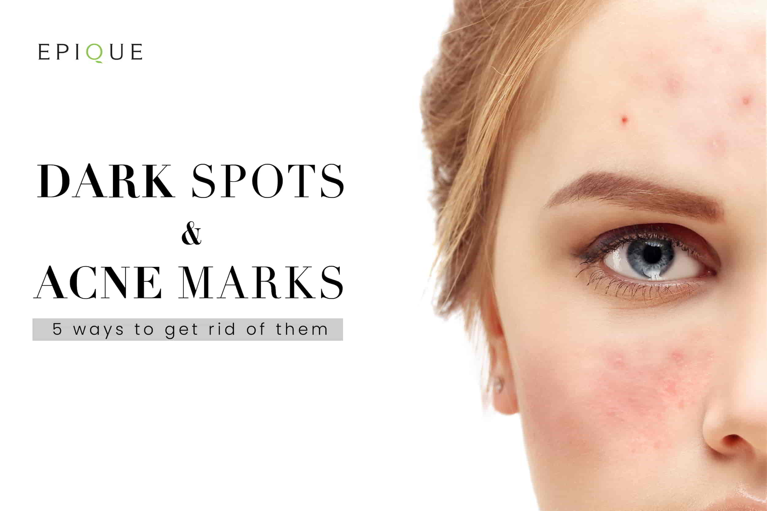 5 Tips by Experts on How to Remove Acne Scars, Dark Spots on Face!