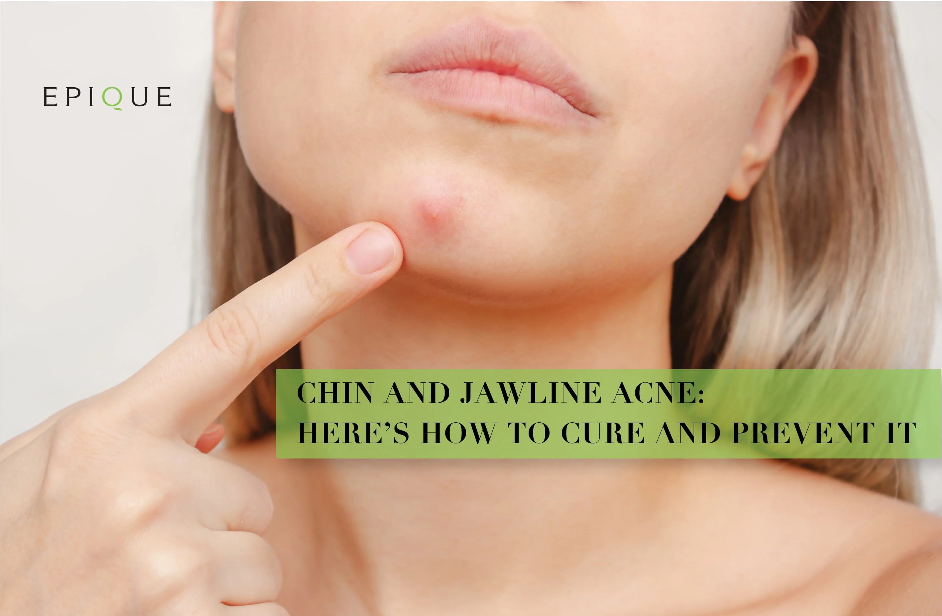 Acne on Chin and Jawline: What Causes It & How to Prevent It?